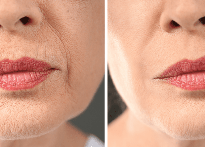 How Much Does A Face Lift Cost Uk