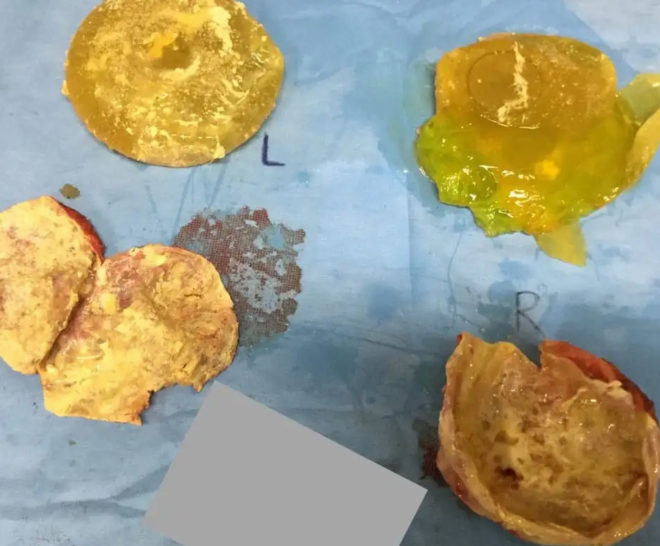 Breast implant rupture after removal