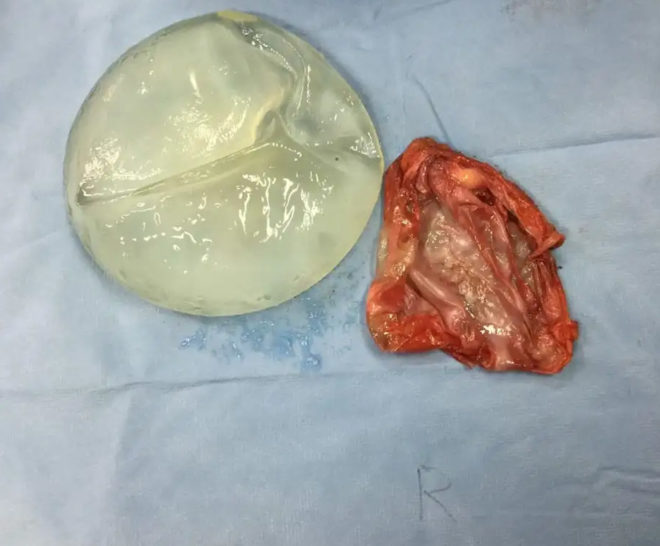 Healthy implant and capsule after removal