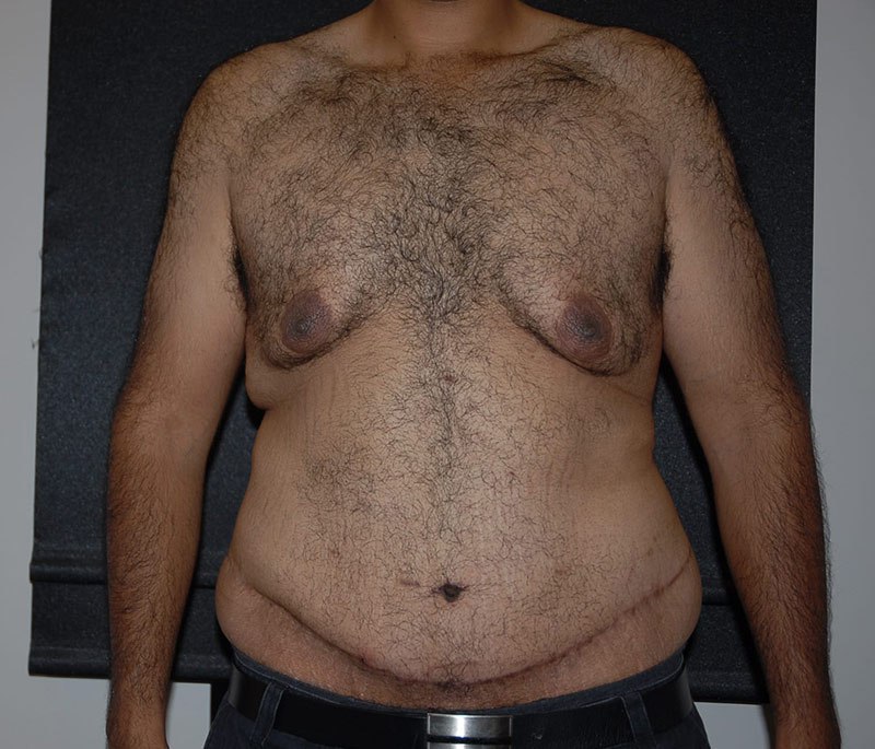 Body Lift after photo - The Lotus Institute 