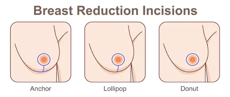 Do I Need a Breast Reduction or Just a Breast Lift?