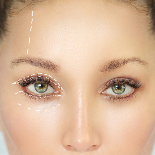 upper or lower eyelid surgery