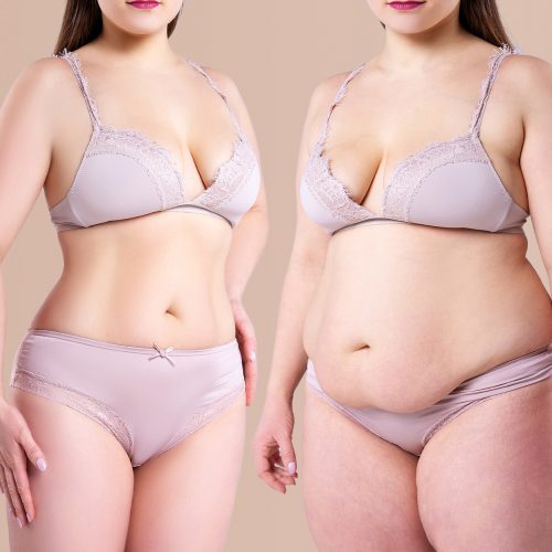 tummy tuck