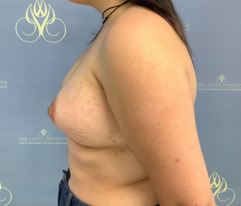 Patient 13: After - Breast Augmentation