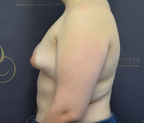 Patient 13: Before - Breast Augmentation