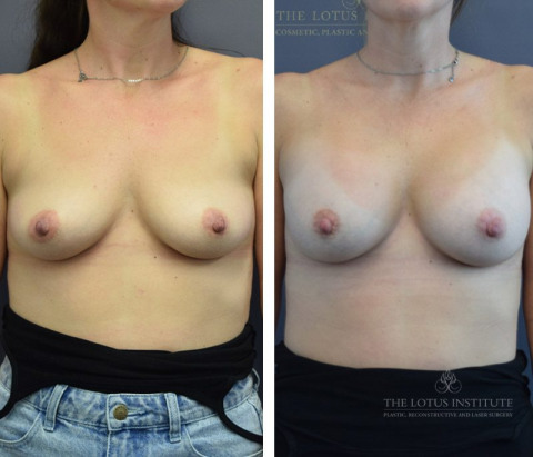 Breast Augmentation