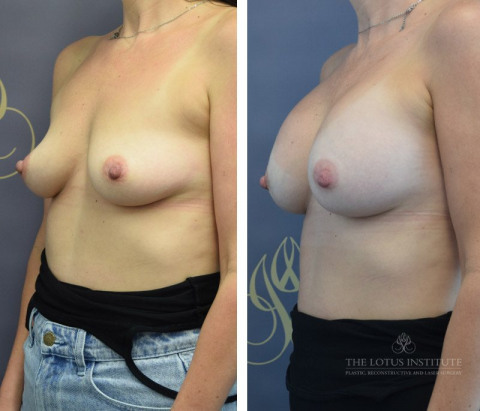 Breast Augmentation