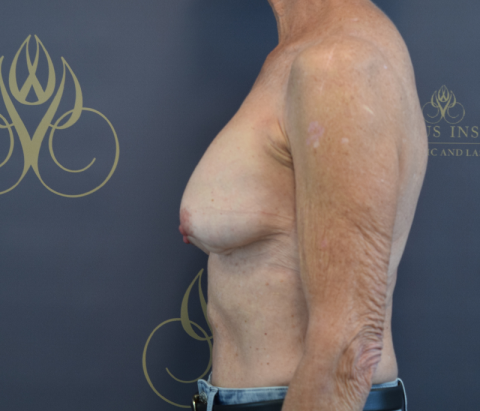 Before: Changeover of Implants & Mastopexy