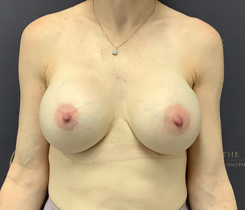 After: Capsulectomy & Changeover of Implants