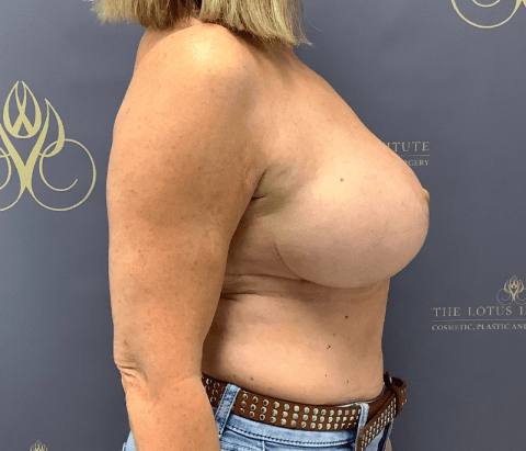 After: Changeover of Implants, Reduction & Triloop Bra Pocket Mesh