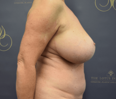Before: Changeover of Implants, Reduction & Triloop Bra Pocket Mesh