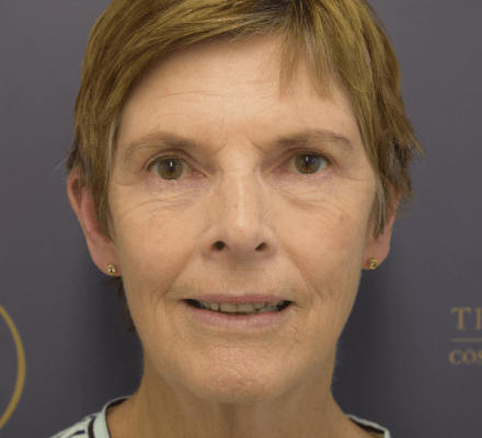 Lotus | Before & Afters | For Website - Bilateral Blepharoplasty - After
