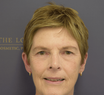 Lotus | Before & Afters | For Website - Bilateral Blepharoplasty - Before