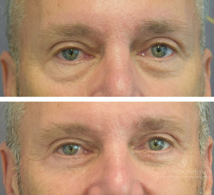 Lower Blepharoplasty