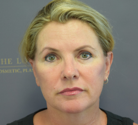 After: M.I.F.A.C.E with Platysmoplasty, Upper Blepharoplasty & CO2 Laser