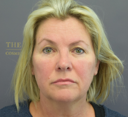 Before: M.I.F.A.C.E with Platysmoplasty, Upper Blepharoplasty & CO2 Laser