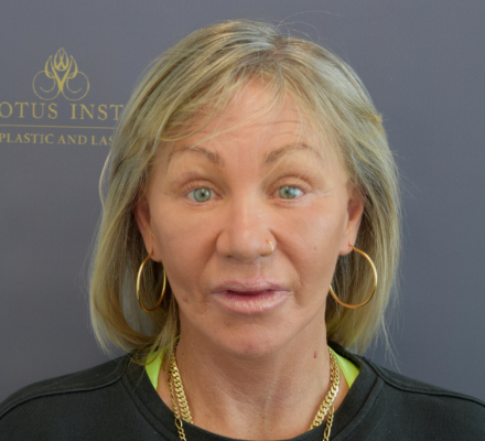 After: Face Lift with Platysmoplasty & CO2 Laser