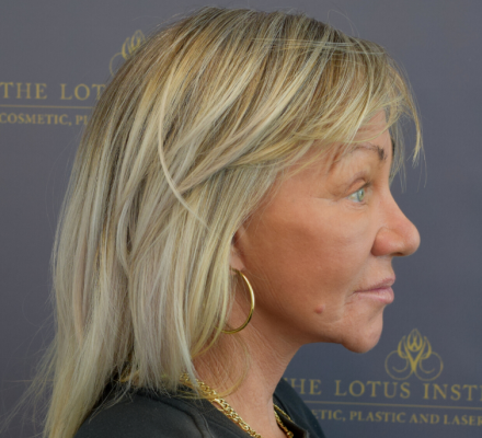 After: Face Lift with Platysmoplasty & CO2 Laser