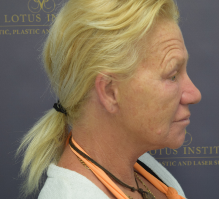 Before: Face Lift with Platysmoplasty & CO2 Laser