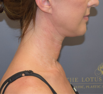 After: Neck Lift