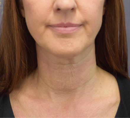 Before: Neck Lift