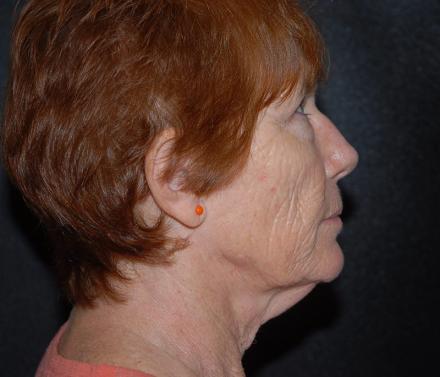 Before M.I.F.A.C.E. & Platysmoplasty