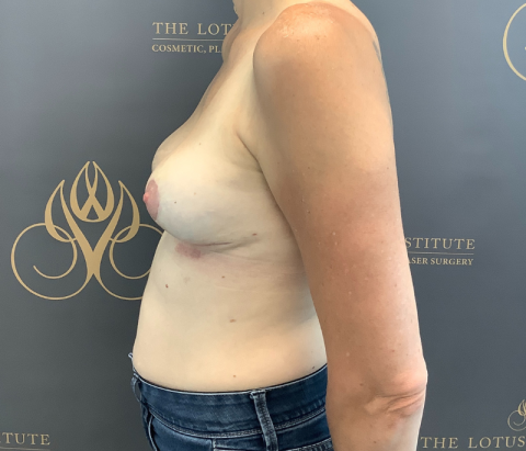 Patient 11: After w/ Capsulectomy