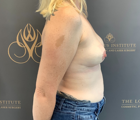 Patient 12: After w/ Capsulectomy