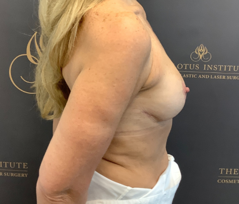 Patient 13: After