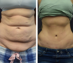 Abdominoplasty