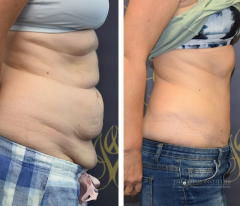 Abdominoplasty