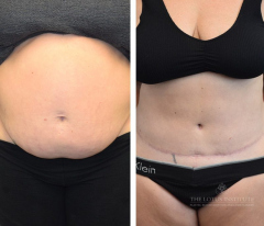 Abdominoplasty